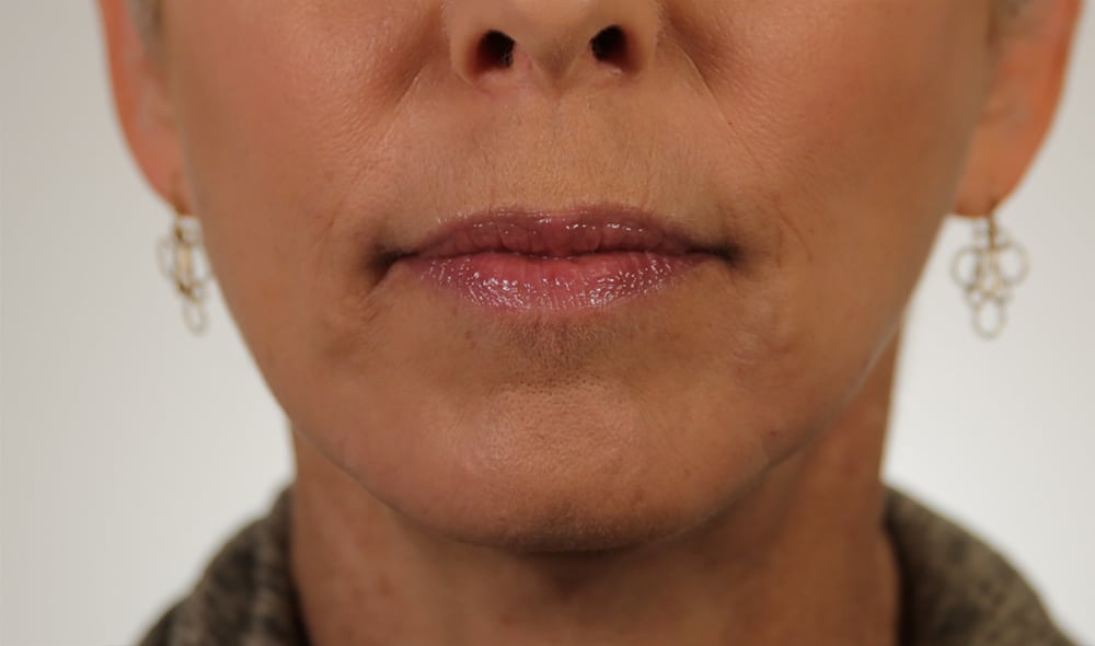 After image, taken within 2 hours of the treatment, shows a natural, but noticeable difference in the reduction of wrinkles and increased smoothness in the treated areas.