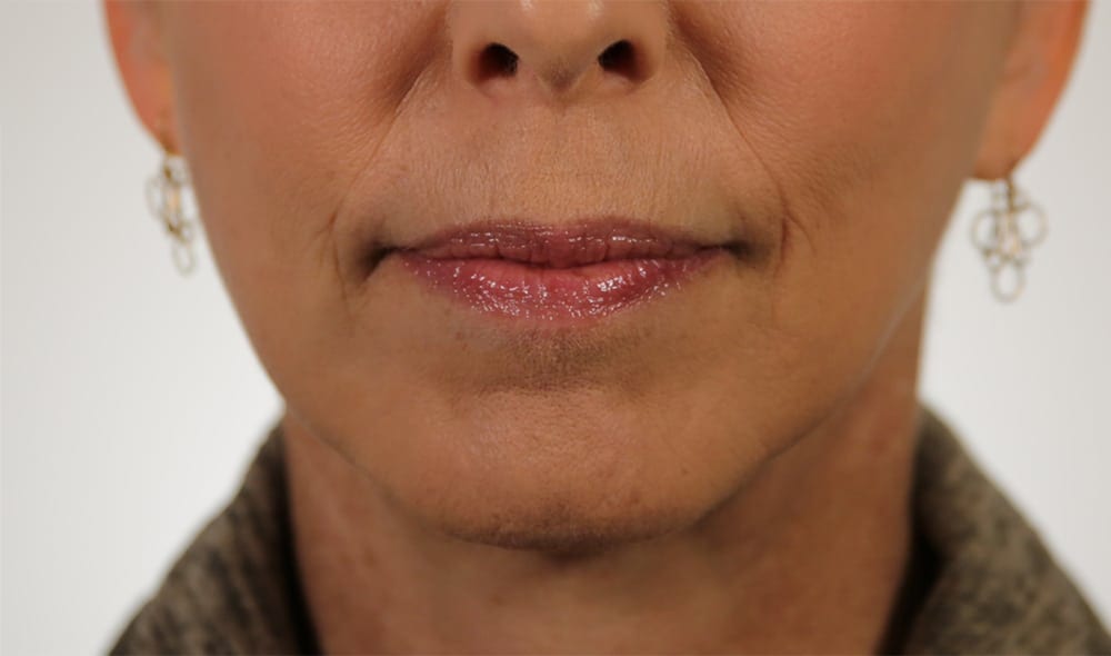 Before patient had moderate lines appearing from the base of her nose to the outer corners of her mouth. She also had some wrinkling in the corners of her mouth.