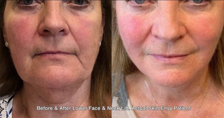 EUROTHREADLIFT IS HERE - News - Skin Envy Austin