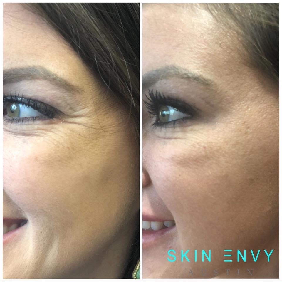 Botox Cosmetic 20 Units Skin Envy Botox Cosmetic 20 Units Skin Envy