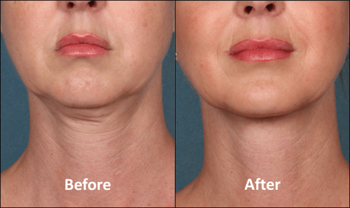 KYBELLA-Patient-Before-and-After-photo
