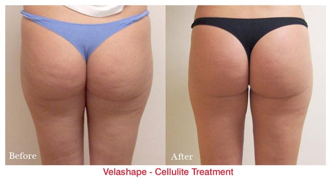 VelaShapeCellulite