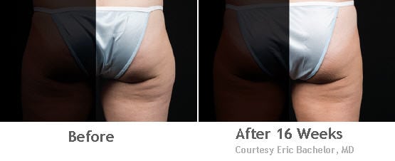 coolsculpting-outer-thighs